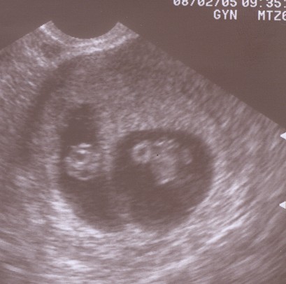 ultrasounds at 8 weeks. first days